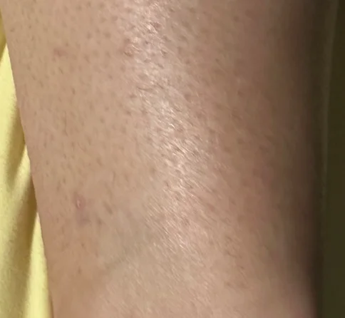 After: the same ankle after laser tattoo removal