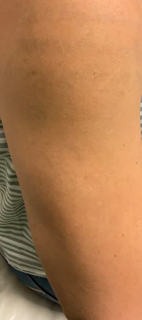 After: the same forearm after laser tattoo removal