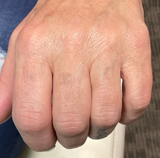 After: the same knuckles after laser tattoo removal
