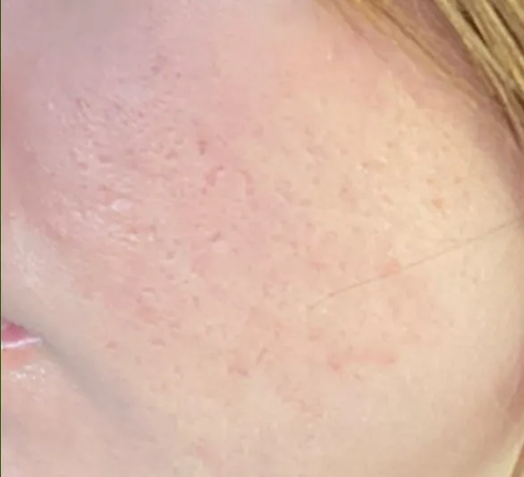 After: the same cheek with smoother texture after laser resurfacing